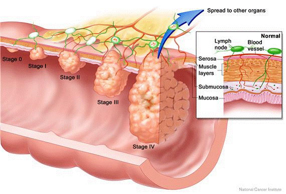 colon-cancer-staging-1-1