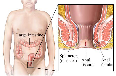 hemorrhoids fistulas